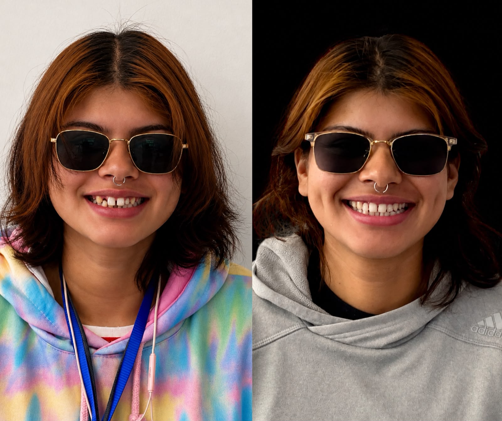 Antes y después de rehabilitación dental en Dental Wox, Guadalajara